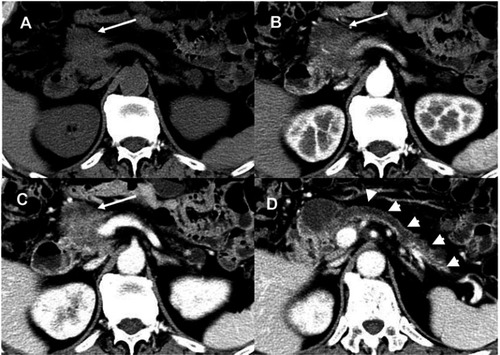 Figure 3 A 65-year-old man with pancreatic ductal adenocarcinoma. (A) Unenhanced image demonstrates an isodense mass (arrow) located in the head of the pancreas. Arterial (B) and portal venous (C) phase images show an ill-defined mass (arrows) presenting a hypovascular enhancement pattern with spleen artery invasion. (D) Main pancreatic duct lumen dilatation and pancreatic parenchymal atrophy were observed (arrowheads).