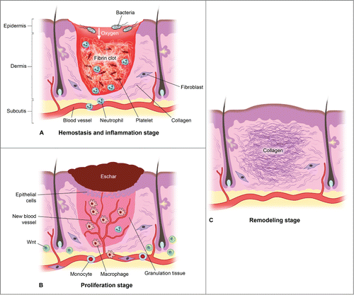 Figure 3. There are 3 classic stages of wound repair: inflammation (a), proliferation (b) and remodeling (c). (a) Inflammation. This stage lasts until about 48 h after injury and depicted is a skin wound at about 24–48 h after injury. The wound is characterized by a hypoxic (ischemic) environment in which a fibrin clot has formed and platelets aggregate. Platelets adhere to the injured endothelium and release chemokines, thereby attracting the cellular components of the inflammatory stage. The inflammatory stage of wound healing is characterized by the presence of neutrophils, macrophages, lymphocytes and local Wnt signaling begins to increase. The inflammatory cells then serve to release proinflammatory cytokines, growth factors and vascular endothelial growth factor, ingest foreign materials, increase vascular permeability, and promote fibroblast activity. (b) Proliferation. This stage occurs about 2–10 d after injury and depicted is a skin wound at about 5–10 d after injury. This stage includes an increased local Wnt response, capillary growth and granulation tissue formation occur and an eschar has formed on the surface of the wound. (c) Remodeling. This stage lasts for a year or longer and depicted is a skin wound about 1–12 months after repair. The final stage of wound healing is a long process of tissue remodeling and increasing wound strength. During this stage, type I collagen synthesis and turnover continues, and fibroblasts differentiate into myofibroblasts, allowing further wound contraction.