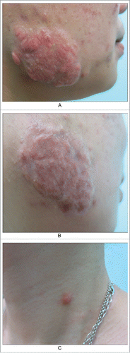 Figure 4. A keloid after acne in cheek. A. Before; B. After six months of treatment, scars flattened. But epidermoid cysts were found around the scar. C. A epidermoid cyst which is already scarring.