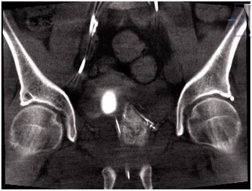 Figure 2. Cone-beam CT (CBCT) in coronal projection, showing contrast filling of prostate parenchyma and, thereby, correct catheter position prior to injection of particles in Prostate Artery Embolization (PAE) treatment.