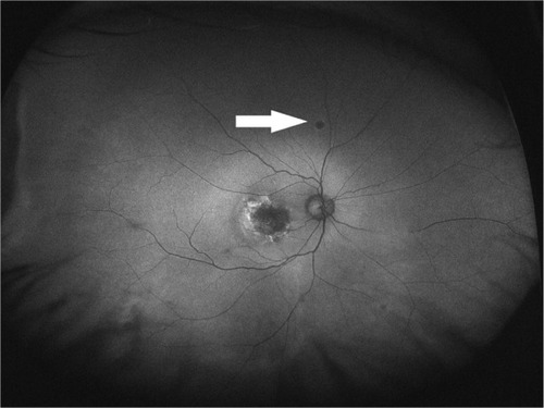 Figure 4 Optos® image of an eye with nummular pattern from a wet age-related macular degeneration patient.