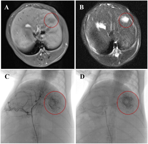Figure 7. Conventional MRI images of rabbit VX2 liver tumor after implantation for 2 weeks: (A) round low-signal nodules in the left lobe of the liver on T1WI, (B) heterogeneous high-signal tumors on T2WI; (C) Hepatic arteriography showed that the tumor was supplied by the left hepatic artery with abundant blood supply and irregular contrast agent filling areas in the tumor; (D) The retention of MVLs in the tumor area observed in the retaken angiography after trans-hepatic arterial injection of MVLs.