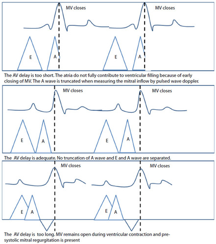 Figure 1 Echocardiographic optimization of atrioventricular delay using the iterative method.
