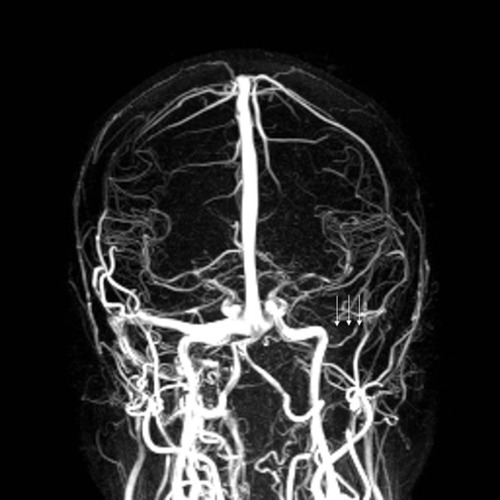 Figure 4 Magnetic resonance venogram following resection of a left vestibular schwannoma showing absence of filling of the left transverse venous sinus (arrows) due to a transverse venous sinus thrombosis.