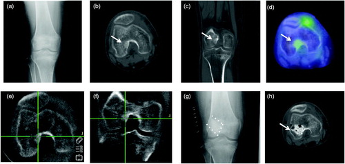 Figure 1. A 40-year-old female patient with the tumor of distal femur (#4). (a) Antero-posterior radiograph did not show the tumor clearly. (b, c) Axial and coronal views of computed tomography showed an obscure sclerotic lesion at the lateral epicondyle near the joint space. (d) Positron emission tomography showed positive FDG uptake in the tumor. (e, f) Axial and coronal views of the intraoperative 3D C-arm image. (g) Curettage was performed with the navigation system and reconstructed with artificial bone. (h) Postoperative computed tomography confirmed complete resection of the tumor.
