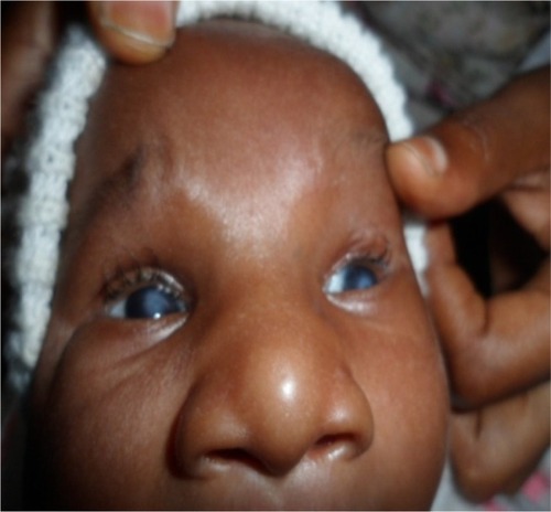 Figure 1 Bilateral cornea opacity, broadening of the nose base and microcephaly.