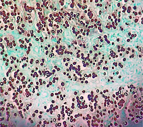 Figure 6 Histological section showing round and oval yeast-link structures with birefringent membrane, with isolated and Rosario beads distribution, commonly found in Jorge Lobo’s disease.