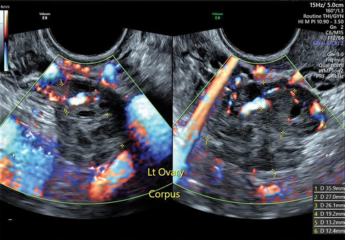 Figure 3. Left ovary: normal. Size: 36 mm x 27 mm x 26 mm. Volume: 13.2 ml. Corpus luteum: 19 mm x 13 mm x 13 mm, solid.