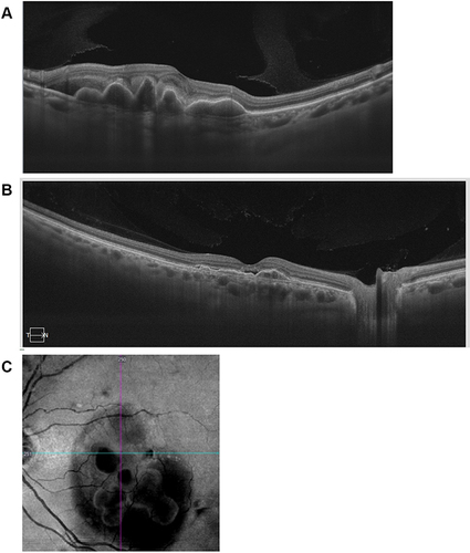 Figure 2 OCT features of PCV.