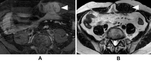 Figure 3 The MRI in April 2018 showed the mass of 40mm in the left rectus abdominis muscle. The mass showed low intensity area like muscle in T2 weighted images (A). It was uniformly enhanced (B). The triangle points to the tumor.