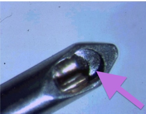 Figure 1 The inner bore of the Cetus probe (A.R.C. Laser, Erlagen, Germany). The titanium inside edge of the probe is the targeting spot for this nanosecond laser. Pulsing the laser emits a plasma formation, and a focused abrupt ultrasound surge is emitted from this point that extends outwards. The probe serves as the aspiration port as well, thus engaging the cataract fragments. The outer silicone sleeve in the coaxial version of the probe used provides the irrigation.