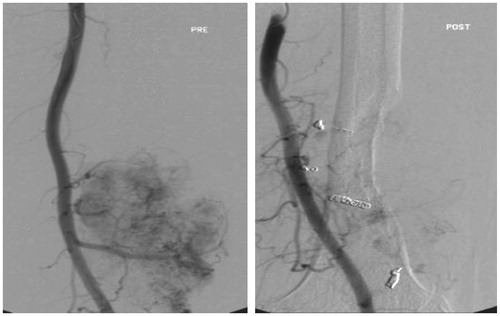 Figure 1. Preoperative embolization performed on a tumor measuring 13 cm located in the distal femur. Since only some residual peripheral tumor enhancement was seen, this was considered to be an adequate embolization outcome. A marginal resection and endoprosthetic replacement resulted in an IBL of 1.3