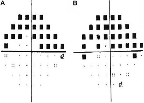 Figure 1 In 2008, Humphrey visual fields show left dense superior field loss with MD of −12.37 dB (A) and in 2010, progressive field loss with MD −14.25 dB threatening fixation is noted (B).