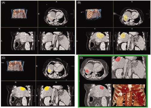 Figure 2. Comparison of semi-automatic (A–C) and manual (D) ablation zone assessment after MWA of a tumor located in the hepatic dome. SAFIR provides a VRT visualization including the position of the virtual antenna in the upper left window and multiplanar reformations (MPR) in the remaining viewer windows. (A) A line (red) corresponding to the maximal diameter of the ablation zone is drawn manually on an axial post-interventional image. In addition, transient hyperemia (white arrows) surrounding the actual ablation zone can be appreciated. (B) Initial results after automatic ablation zone segmentation (yellow) with superimposed antenna position. Notably, there is obvious incongruence between the real and the automatically segmented ablation zone, as the surrounding hyperemia has been mistakenly accounted for part of the ablation zone. (C) Final semi-automatic ablation zone segmentation result (yellow) after manual adjustments of ablation zone boundaries. (D) Manual evaluation of the ablation zone (highlighted in red) in the same patient.