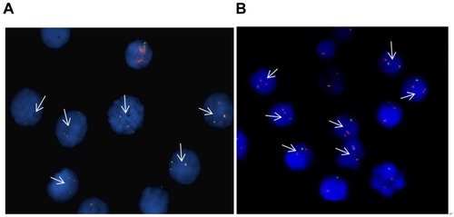 Figure 1 FISH detection of the two cell lines of MLL-rearranged acute leukemia. Arrow: positive signal cells (one red, one green, and one fusion signal), (A) THP-1 cells, (B) RS4:11 cells.