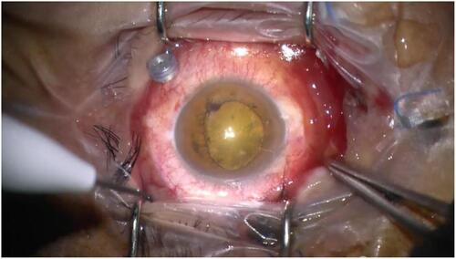 Figure 2 Intraoperative view of the anterior segment showing the dense traumatic cataract.
