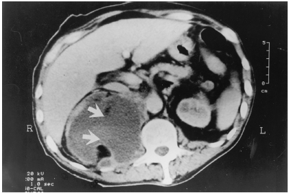 Figure 2. Abdominal CT demonstrating large loculated abnormal fluid collection right posterior para-renal region extended into the psoas muscle (arrows). The lesion size about 18 × 9 × 7 cm.
