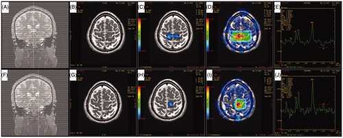 Figure 1. Illustrations of two different magnetic resonance spectroscopy imaging (MRSI) methods and their resulting spectra. (A, F) Coronal view of calibration scan in a routine MRSI method (upper row) and the localized MRSI method (lower row). (B, G) Positioning of the region of interest and the position of the target voxel. (C, F) N-acetyl aspartate (NAA) concentration map automatically generated by the Functool software. Voxels from the blue area (Shown as gray area in the Print version) have higher NAA concentration. Note that the target voxel is fully included in the blue area (Shown as gray area in the Print version) by the localized MRSI method (F). (D, I) Signal-to-noise ratio (SNR) distribution map automatically generated by the Functool software. Voxels from the red area (Shown as dark area in the Print version) have better SNR. Target voxel is not included in the red area (Shown as dark area in the Print version) by the routine MRSI method (D). (E, J) Spectra of the same target voxel from two MRSI methods. The resulting SNR is 1.42 and the NAA concentration is 129 528 arbitrary MR units with routine MRSI method (E), while the SNR is elevated to 2.04 and NAA concentration is elevated to 172 872 arbitrary MR units with the localized MRSI method (J).