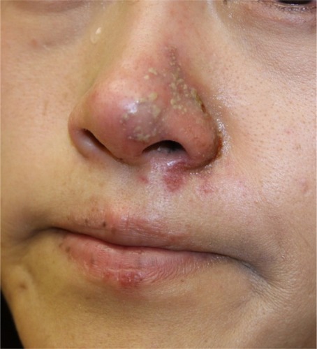 Figure 7 Dermal filler injection leading to herpes virus reactivation.