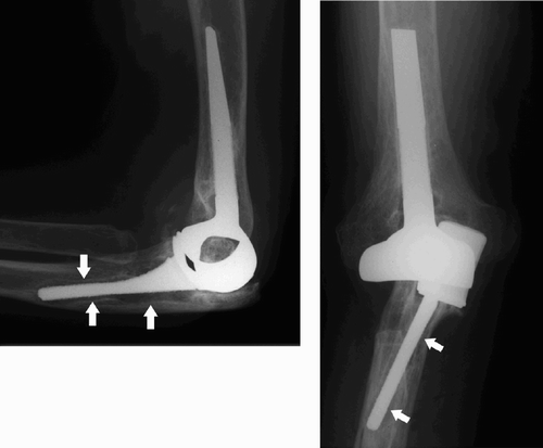 Figure 4. Lateral and AP radiographs of the same prosthesis as in Figure 3, 2 years after insertion. There is marked osteolysis around the ulnar stem (white arrows).