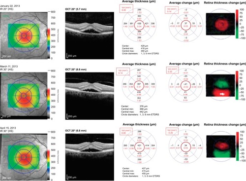 Figure 2 Patient with CSCR, treated with eplerenone 25 mg twice-daily from January to March 2013.