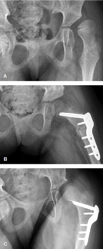 Figure 2. A. Preoperative radiograph of a girl, aged 8.1 years and GMFCS level V, with severe subluxation of her left hip (MP 74%). B. 6 weeks after femoral and pelvic osteotomies of the left hip and bilateral soft tissue releases, showing good femoral head coverage. C. 2.9 years postoperatively (age 11.0 years), showing relapse of subluxation of her left hip (MP 51%).