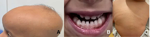 Figure 2 (A) Frontal bossing, (B) Hypoplastic teeth, (C) Multiple skin-colored papules over the back.