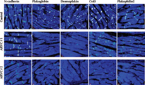 Figure 2. Representative confocal immunofluorescence images of control myocardium and myocardium from two patients with autosomal dominant ARVC. Specific immunoreactive signal for plakoglobin was depressed at cell–cell junctions in the great majority of cases regardless of the underlying pathogenic mutation. Signal for desmoplakin and plakophilin2 varied, while signal for N-cadherin was always present and indistinguishable from controls. The majority of cases examined showed gap junction remodeling as evidenced by decreased junctional signal for Cx43 (reproduced from Asimaki et al. NEJM 2009; 360:1078) (CitationAsimaki et al., 2009).