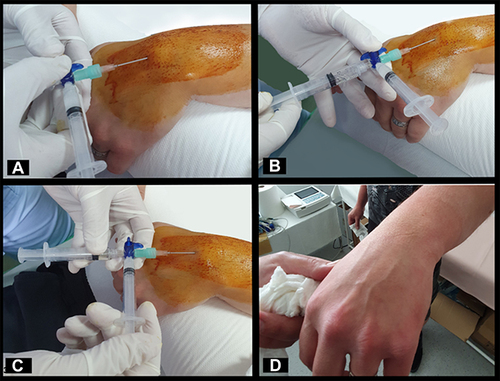Figure 3 Technique presentation for aspiration/injection procedure of a wrist synovial cyst; (A) approach and needle placement was done after understanding local anatomy with sonography, with wide skin preparation and sterile technique under local anesthesia; (B) aspiration of cyst content; (C) injection of corticosteroid after aspiration is completed; (D) 6 week follow-up visit with clinical assessment (patient used compressive bandage during activities after the procedure).