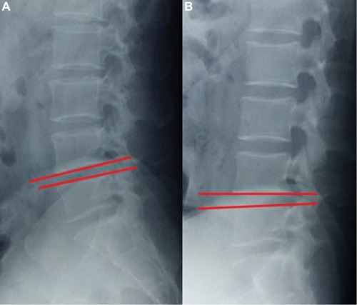 Figure 2 Lumbar mobility was calculated as the difference of LL on flexion (A) and extension (B) lateral radiographs.