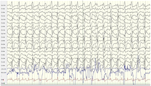 Figure 7. Initial EEG of a 42 year old woman two days after cardiac arrest.