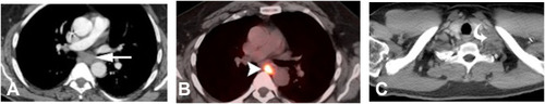 Figure 6 Distant lymph-node metastases. (A) Chest CT soft-tissue window showing subcarinal mediastinal lymphadenopathy with corresponding PET-CT. (B) Increased FDG avidity. (C) Left supraclavicular lymphadenopathy in axial CT with soft-tissue window settings.