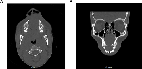 Figure 3 (A and B) axial and coronal views of CT scan showing a rounded radiolucency on the anterior maxillary wall bulging into the anterior hard palate and left nasal cavity.