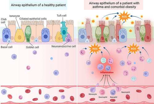 Figure 2 Oxidative stress in patients with asthma and comorbid obesity contributes to persistent immune cell recruitment and inflammation, leading to airway epithelium permeability. Left: The airway epithelium of healthy patients is comprised of several different cell types, including club cells, basal cells, ionocytes, ciliated epithelial cells, goblet cells, tuft cells, and neuroendocrine cells, which are attached to the basement membrane. The pseudostratified epithelium provides a sealed barrier to prevent environmental particles from infiltrating the lung tissue. The submucosal area lies between the basement membrane and blood vessels. Immune cells, such as macrophages, lymphocytes, eosinophils, and basophils are located within both the submucosal area and blood vessels. Right: In the presence of allergenic, viral, or air pollution particles that exacerbate asthma, immune cells are recruited from the blood stream into the submucosal area. These activated immune cells produce ROS in response to these provocative agents. Recurrent exacerbations and oxidative stress cause more inflammation and damage to the epithelial cells, resulting in epithelium permeability. In patients with obesity and asthma, inflamed adipose tissue serves as an additional source of oxidative stress, which may accelerate epithelial damage and barrier permeability. Created with BioRender.com.