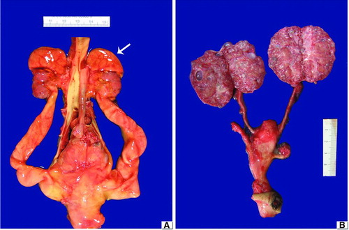 FIGURE 1  (A) Obstructive MCDK. Notice the hypoplastic kidneys with the adrenal glands still at the upper poles (arrow). The aorta is centrally located and there are bilateral hydroureters. (B) Nonobstructive MCDK. The ureters are unremarkable and portions of the two umbilical arteries run parallel to the urinary bladder. The kidneys are bi-valved to demonstrate numerous small cysts scattered through the cortex and medulla. 101 × 67mm.