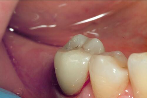 Figure 11 Intraoral photography of monolithic zirconia crown after cementation.