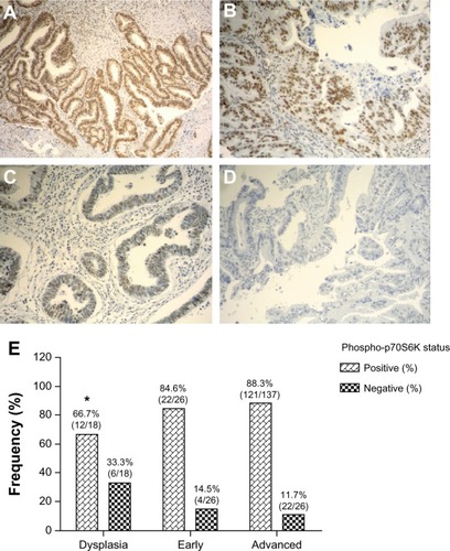 Figure 1 Immunohistochemical staining of phospho-p70S6K in gallbladder tissue. Representative images from gallbladder lesions showing intense (A), moderate (B), weak (C), and negative intensity (D) staining of phospho-p70S6K. Images represent original magnification 100×. (E) Frequency distribution for positive staining of phospho-p70SS6K in sequential gallbladder lesions.