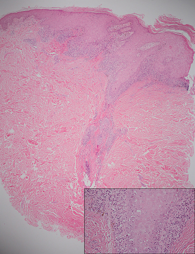 Figure 5 Histopathological examination of hypertrophic DLE showing focal lichenoid, superficial and deep perivascular lymphocytic infiltration with marked epidermal hyperplasia (H&E, ×4); perifollicular interface changes with necrotic basal keratinocytes (inset, ×40).