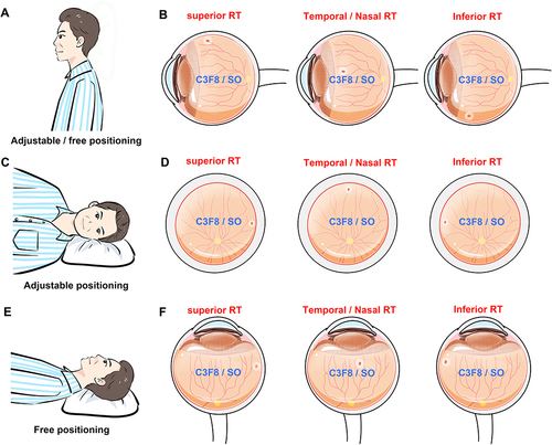 Figure 1 Diagram of retina tear and postoperative positioning. (A) Upright positioning in the adjustable or free positioning. (B) The location of the superior, temporal/nasal and inferior retina tear (RT) in the upright positioning. (C) Lateral positioning in the adjustable positioning. (D) The location of the superior, temporal/nasal breaks and inferior RT in the lateral positioning. (E) Face-up positioning in the free positioning. (F) The location of the superior, temporal/nasal and the inferior RT in the face-up positioning.