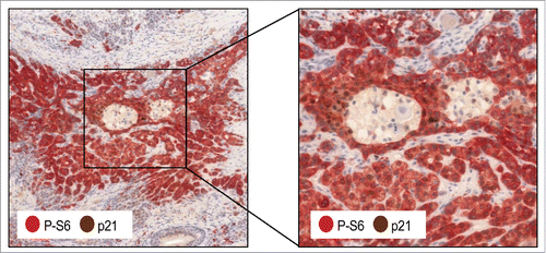 Figure 1. Co-expression of p21 and phosphorylated S6 in head and neck squamous cell carcinoma (HNSCC). Representative section from a HNSCC tissue sample showing immunohistochemical detection of CDKN1A/p21 and phosphorylated-S6 (P-S6).