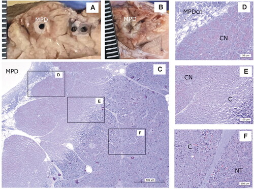 Figure 8. Animal model results. Histopathological findings of 0-day Group. (A,B) Macroscopic view of the main pancreatic duct (MPD) surrounded by a whitish and an erythematous halo. (C–F) Microscopic image (H&E): MPD with wall collagen necrosis (MPDcn) surrounded by three zones: Coagulation necrosis (CN) with intense zymogen granules eosinophilia (D), congestion (C) with disaggregated acini (E) and normal tissue (NT) (F). Scale in mm.