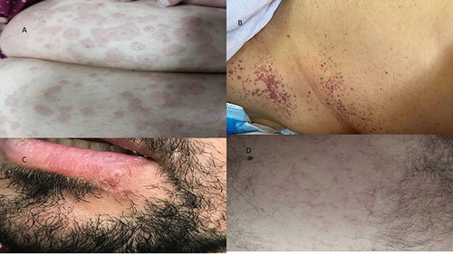 Figure 2 Cutaneous manifestations of COVID-19; (A) erythema multiforme, (B) petechial rash, (C) herpes simplex, (D) urticarial rash.