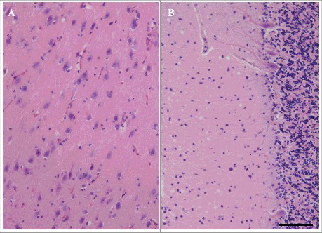 Figure 3. Microscopic findings of HE staining of the hippocampus (CA1) (A) and cerebellum (B) in patient 5. Mild neuronal loss, gliosis, and spongiform change are shown. Scale bars: 100 μm HE, hematoxylin and eosin.