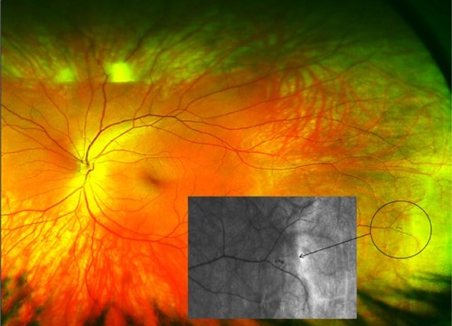 Image 1 Nonmydriatic, ultrawide field image of a peripheral retinal hemorrhage adjacent to an area of retinal thinning (area in circle) in a 26-year-old, healthy, asymptomatic subject.