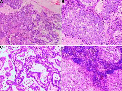 Figure 5 The pathological findings of the resected pulmonary mass. (A) The mass combines two components, including hepatoid adenocarcinoma (HAC) of the lung and lung adenocarcinoma. (B) The pathological results of pulmonary hepatoid adenocarcinoma. The cytoplasm of tumor cells is abundant, and nuclei are markedly enlarged with prominent eosinophilic nucleoli. The individual neoplastic cells resemble hepatocytes. (C) The pathological results of lung adenocarcinoma. The tumor cells show acinar, micropapillary, and papillary with significant atypia. (D) The lymph nodes show HAC cells metastasis.