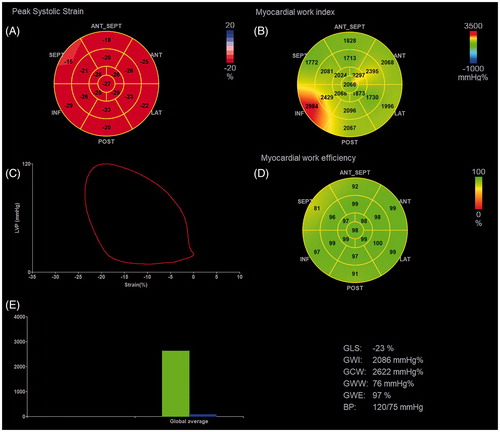 Figure 1. Measurement of myocardial work indices derived from left ventricular pressure and strain by echocardiography (A. Bull’s eye of left ventricular global longitudinal strain; B. Bull’s eye of myocardial work index at a blood pressure of 120/75 mmHg; C. LV pressure-strain loop; D. Bull’s eye of myocardial work efficiency; and E. Bar graph showing global constructive work and global wasted work and measured myocardial work values). BP: blood pressure; GCW: global constructive work; GLS: global longitudinal strain; GWE: global work efficiency; GWI: global work index; GWW: global wasted work.