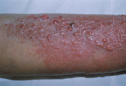 Figure 1.  Myelomatous skin infiltrates. On the extensor surfaces of the legs ten serous bullae are seen, of size 10–20 mm overlying erythemato-edematous plaques; this appearance developed in the 11th month of the disease course.