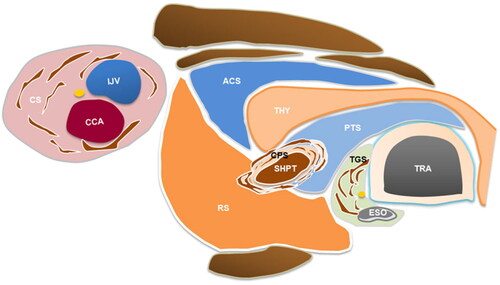 Figure 4. The schematic diagram of different fascial spaces around parathyroid. The schematic diagram of hydrodissected PTS, RS, ACS, CS, CPS and TGS. Note: THY, thyroid; ESO, esophagus; TRA, trachea; CCA, common carotid artery; IJV, internal jugular vein; SHPT, secondary hyperparathyroidism; PTS, pretracheal space; RS, retropharyngeal space; ACS, anterior cervical space; CS, carotid space; CPS, circumferential periparathyroidal space; TGS, tracheoesophageal groove space.