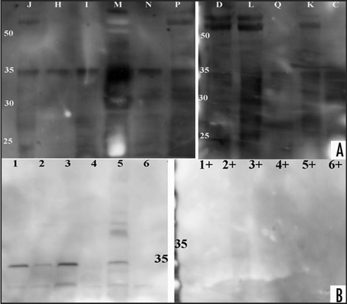 Figure 3 Western blot analysis of urines from CJD, disease and healthy controls. PK treatment of patient and healthy controls and western blot analysis with 3F4-HRP antibody. (A) Proteinase K (concentration 40 µg/ml for 20 min) treatment of CJD and disease control samples. Samples ID letters correspond to Table 1. Proteins were transferred with Iblot apparatus and the membrane probed with 3F4-HRP followed with ECL Plus addition. Membrane documentation was with Kodak Imager with 5 minutes exposure time. (B) Proteolytic digestion of six healthy control urines in presence (+) or absence (−) of proteinase K (concentration 40 µg/ml for 20 minutes). Healthy control samples are shown with numbers 1–6 and are from different gender and age. Protein transfer was with the Iblot apparatus and the membrane probed with 3F4-HRP, followed with ECL Plus addition. Documentation was as described above.
