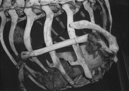 Figure 5. Right lateral view of ostrich (Struthio camelus) chest. Large malignant calcific masses.